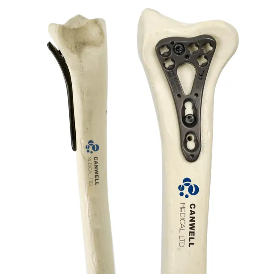 Canwell Variabler Winkel Radius Verriegelungsplatte Orthopädische Implantate Titan Verriegelungsplatte